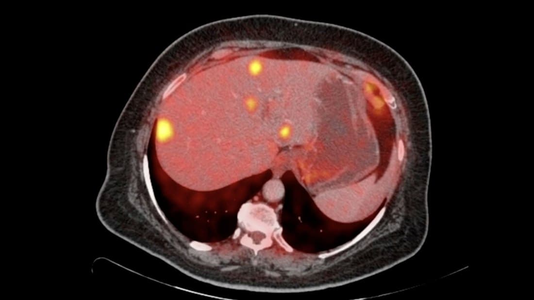 An ultrasound-guided intervention: the pre-operative scan the plan is made from.